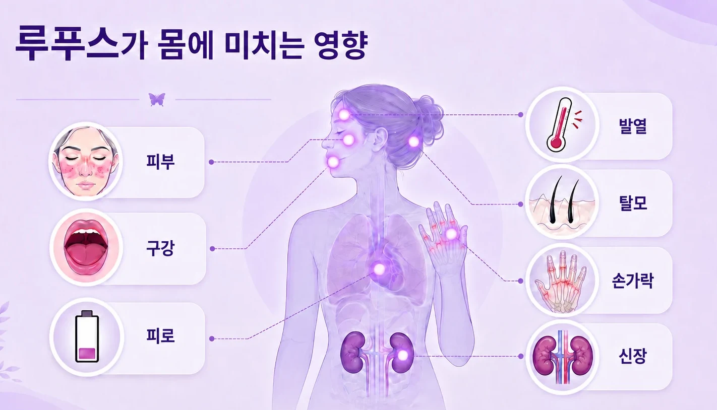 루푸스가 몸에 미치는 영향